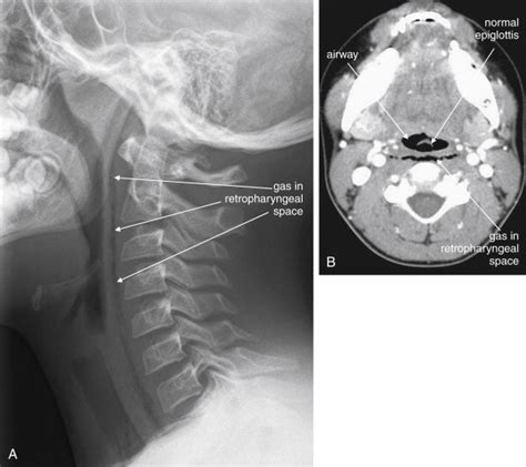 Imaging Soft Tissues of the Neck .